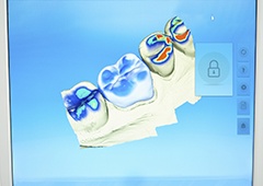 3D scans of teeth on computer