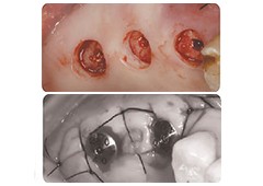 Implant surgery site