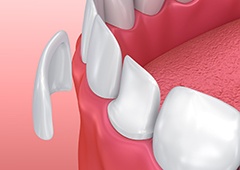 Animation of porcelain veneer placement