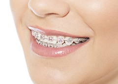 Closeup of teeth with braces