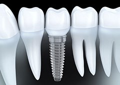 Animation of implant supported dental crown